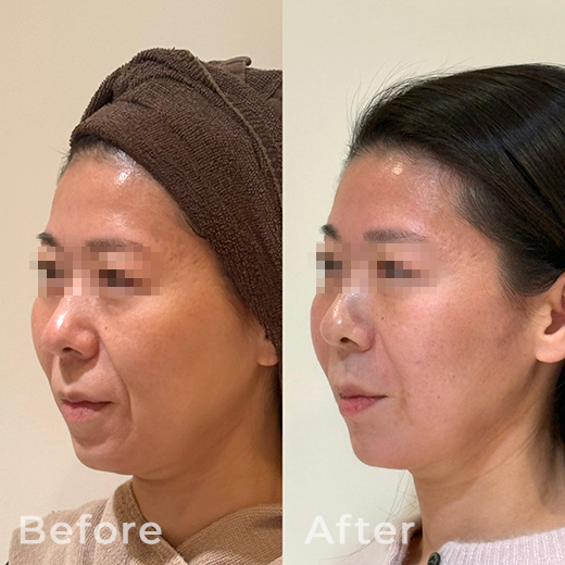 ヒアルロン酸注射の症例写真