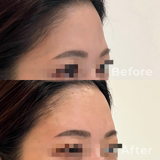 ヒアルロン酸注射の症例写真