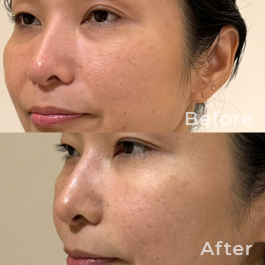 肌育注射の症例写真