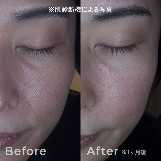 肌育注射の症例写真